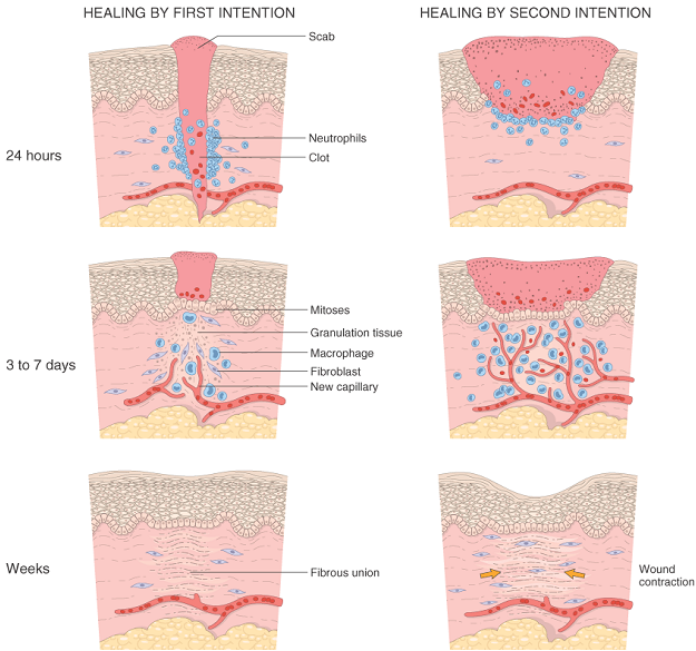 Regeneration healing (repair)General Pathology Lecture note
