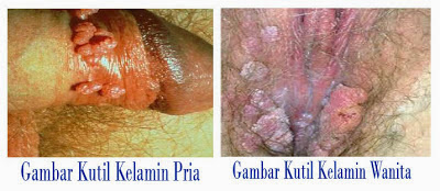 Penyakit kutil kelamin Penyakit kutil kelamin