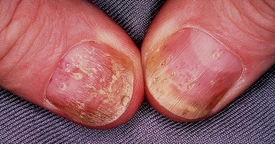 El mundillo el tratamiento de la psoriasis