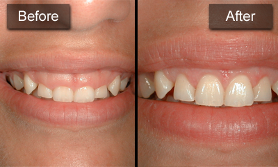 http://www.laserdentalclinicbangalore.com/Dental-Crown-Lengthening.php