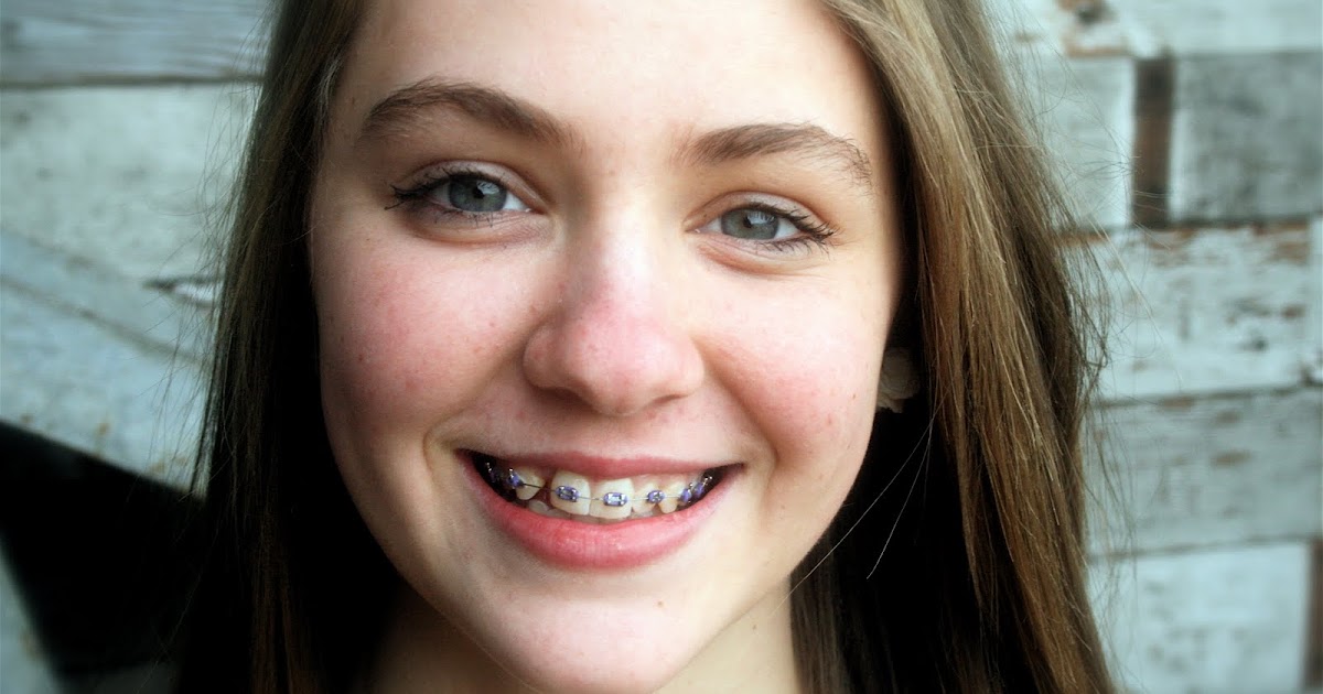 Awfully Beautiful Look who got Braces