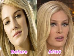5 Disasters of Plastic surgery