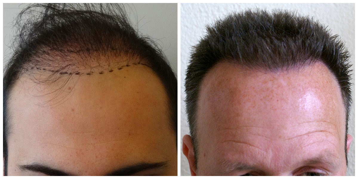 Find Out Why Cheap Tattoo Cheap Hair Transplantation And Cheap