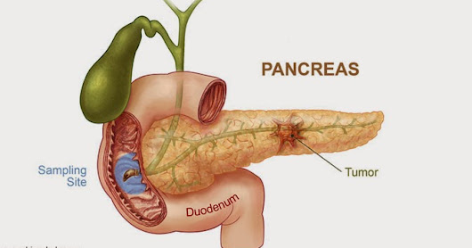Obat Kanker Pankreas ~ Obat Pelangsing Herbal
