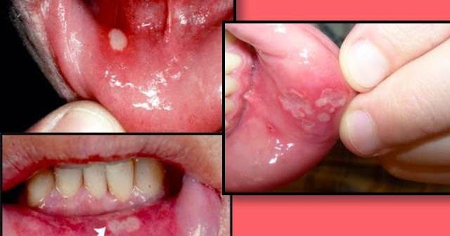 Image Result For Petua Hilangkan Ulser Mulut Bayi Image Result For Petua Hilangkan Ulser Mulut Bayi