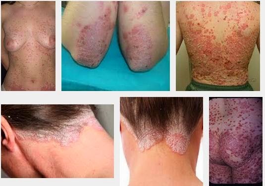 {obat eksim|cara mengobati eksim|cara menyembuhkan eksim|cara menghilangkan eksim|cara mengatasi eksim|pengobatan eksim|obat dermatitis|cara mengobati dermatitis|cara menyembuhkan dermatitis|cara menghilangkan dermatitis|cara mengatasi dermatitis|pengobatan dermatitis|obat eksim kering|obat eksim basah|obat eksim tradisional|obat eksimer|obat eksim di apotik|obat eksim kering menahun|obat eksim menahun|obat eksim kering di apotik|obat eksim paling ampuh|obat eksim herbal|obat eksim kering salep|obat eksim kulit|obat eksim basah menahun|obat eksim mujarab|obat eksim de nature|obat eksim tradisional paling ampuh|obat eksim basah tradisional|obat eksim untuk bayi|obat eksim atopik|obat eksim kering yang manjur|obat eksim alami|obat eksim ampuh|obat eksim apotik|obat eksim anak|obat eksim apa|obat eksim adalah|obat eksim alami ampuh|obat eksim alami paling ampuh|obat eksim alami paling manjur|obat eksim akut|obat eksim ala dokter|obat eksim alami untuk bayi|obat eksim aman untuk ibu hamil|obat eksim ampuh kaskus|obat eksim alergi|obat eksim apa ya|obat eksim ala hembing|obat eksim alami tradisional|obat eksim asi|obat eksim basah di apotik|obat eksim bayi|obat eksim basah dan kering|obat eksim basah salep|obat eksim basah yang ampuh|obat eksim basah pada anak|obat eksim basah yang manjur|obat eksim buat anak|obat eksim berair|obat eksim bernanah|obat eksim basah manjur|obat eksim basah untuk ibu hamil|