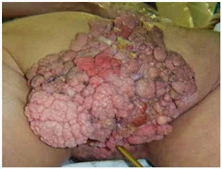 Obat Penyakit Kutil Kelamin Manjur Obat Penyakit Kutil Kelamin Manjur