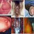 Obat Anti Bakteri Gonore Tuntaskan Sakit Kencing Nanah thumbnail