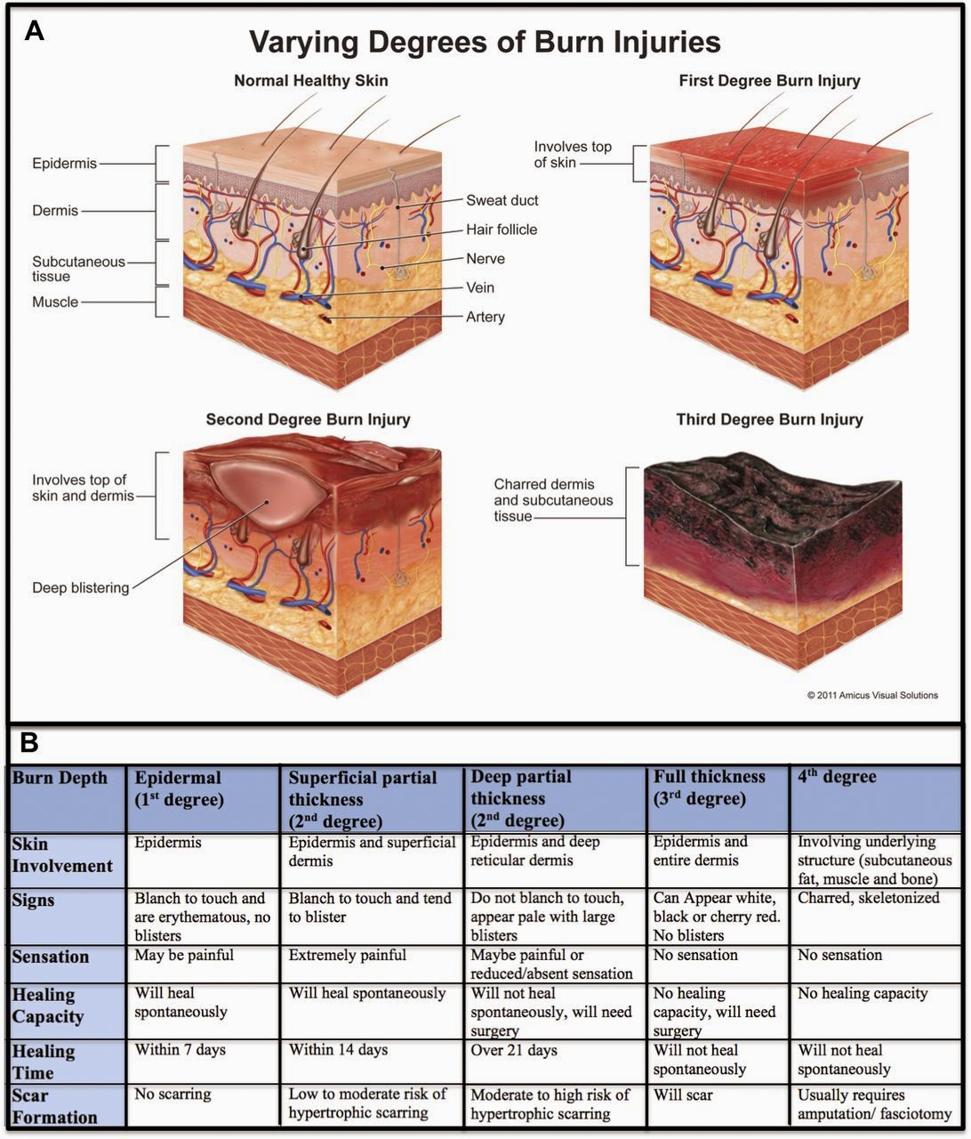 Burn Classification Chart