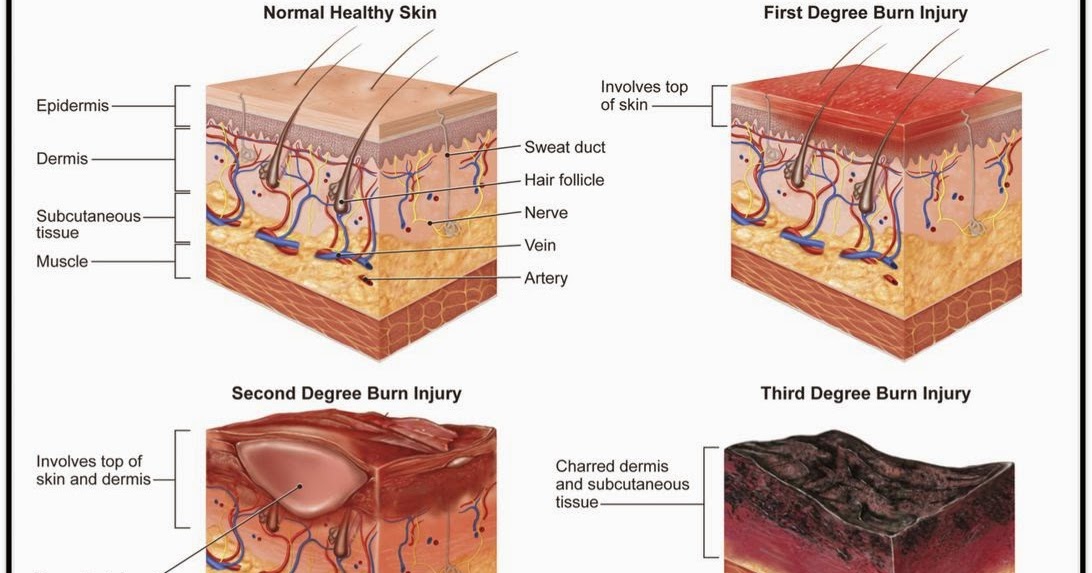 Burn Notice Blog Edition: Diagnosis/Classification of Burns diagram of burns 