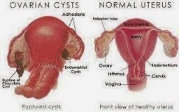 Tanda-tanda Cysts