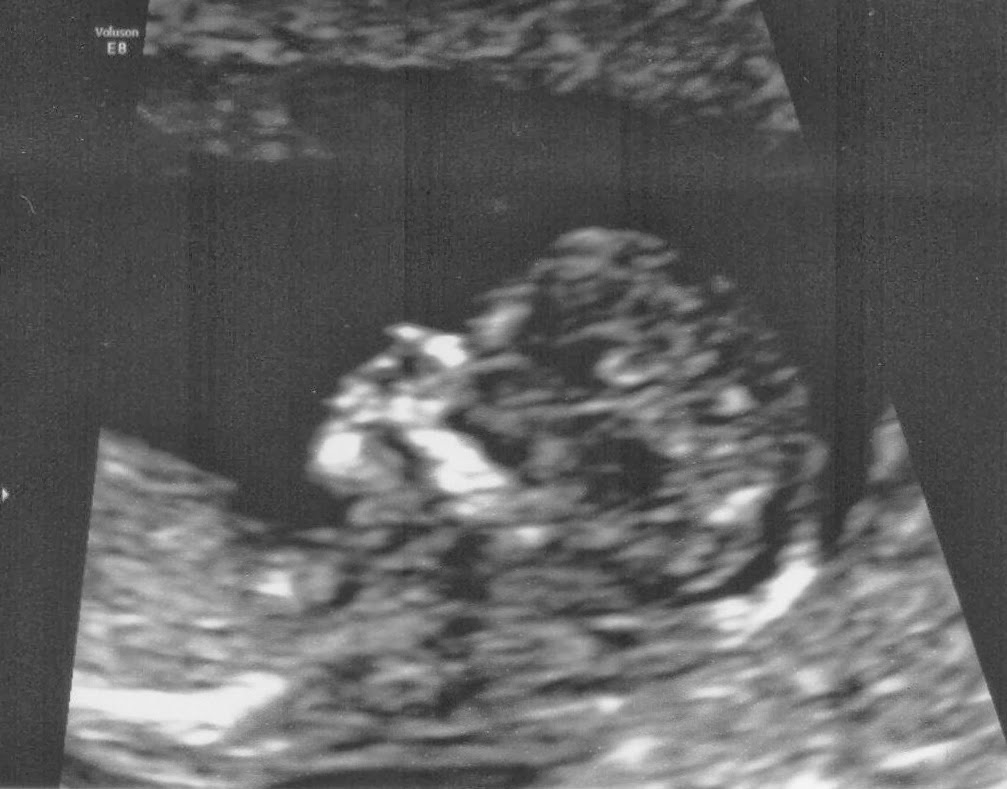 Accuracy of ultrasound dating scan
