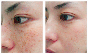 caring n beauty blogspot com apple cider vinegar for hyperpigmentation