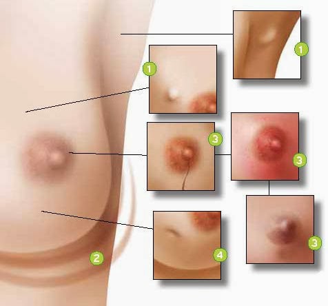 Il silicone si forma per un petto