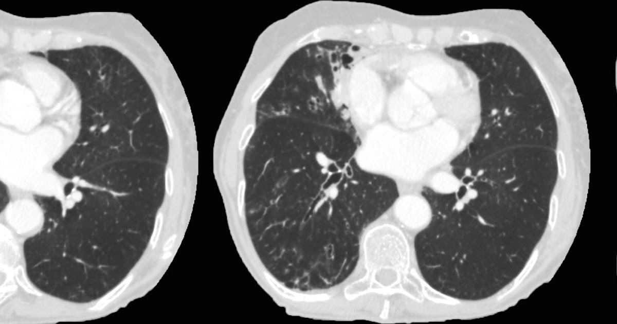Roentgen Ray Reader Lady Windermere Syndrome