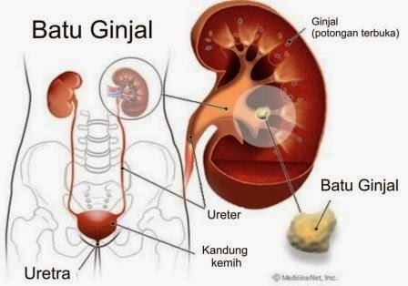 Cara Mencegah Penyakit Ginjal Secara Alami Cara Mencegah Penyakit Ginjal Secara Alami