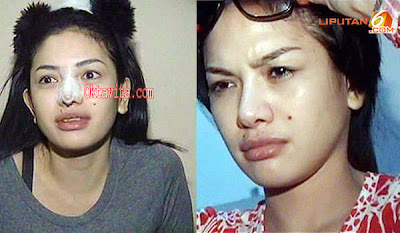 Heboh Foto-foto Nikita Mirzani Sedang Operasi Hidung di Tahun 2013