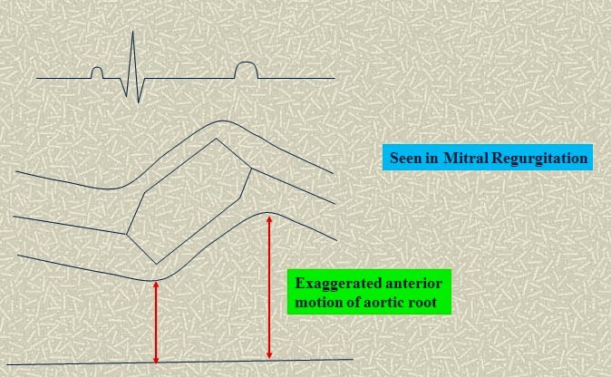 Những giá trị " thú vị " của siêu âm tim M Mode trong chẩn đoán các bệnh lý tim mạch