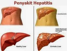 cara mengobati hepatitis b sampai sembuh permanen cara mengobati hepatitis b sampai sembuh permanen