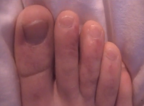 Chilblains Toes