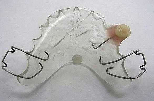 flipper dental partial denture temporary pontic tooth bridge kit impression flippers retainers clear teeth fake hawley false cost bridges coupon