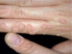 Папилломы в интимных местах лечение