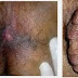 Obat Ambeien Dari Luar thumbnail