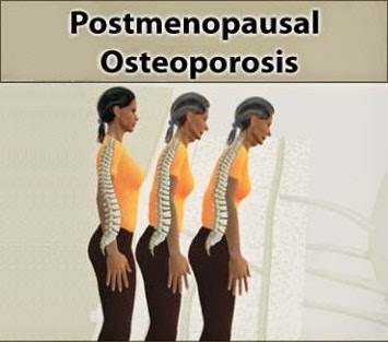 The link Between Osteoporosis and Menopause The link Between Osteoporosis and Menopause