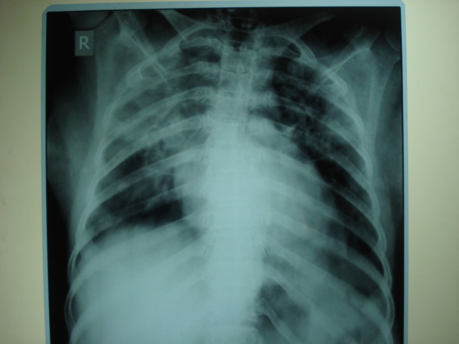 Dr. Sudip Banerjee ACUTE FLUID OVERLOAD SIMULATING UPPER LOBE