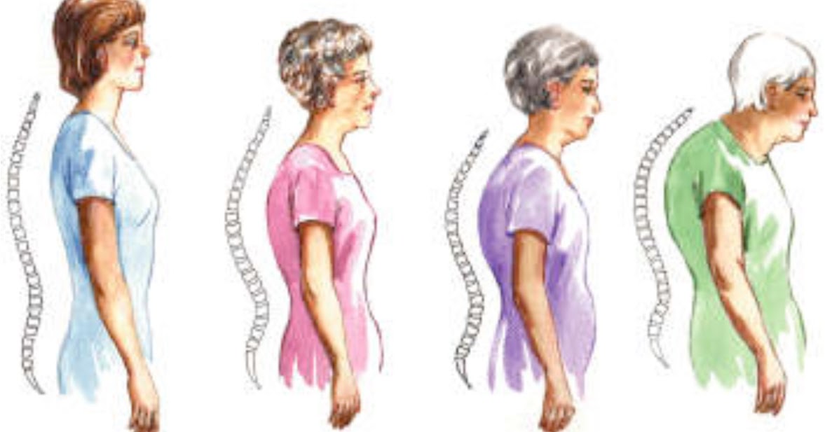 The Pilates Hundred Posture 201 Kyphosis