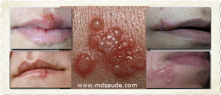 Fotos de herpes labial