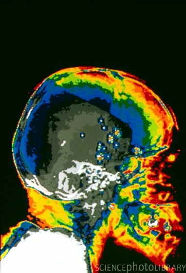 Abnormal+ct+scan+head