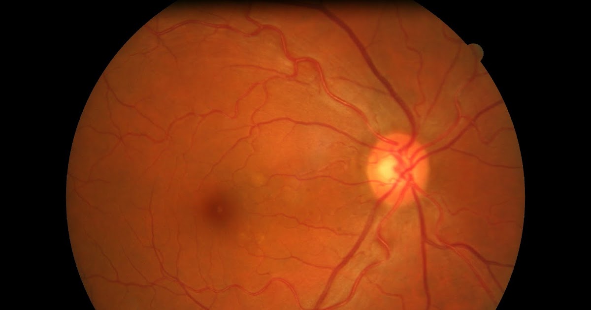 Case of the Day Optometry Blurred vision in the left eye for 2 weeks