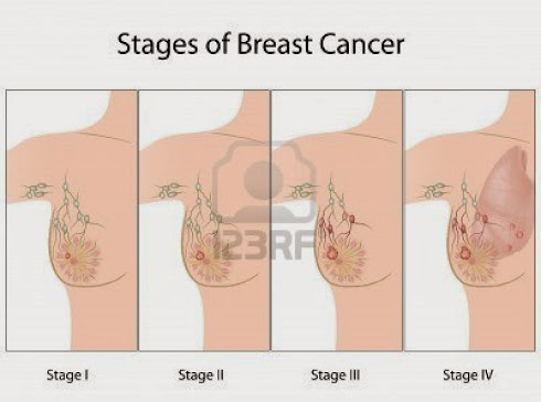 STAGES OF BREAST CANCER