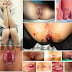Daftar Herga Paket Obat Wasir Di Jual Online thumbnail