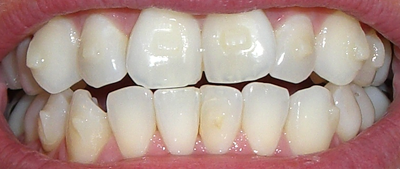 Sneek&rsquo;s Invisalign Treatment: Progress Weeks 9-10