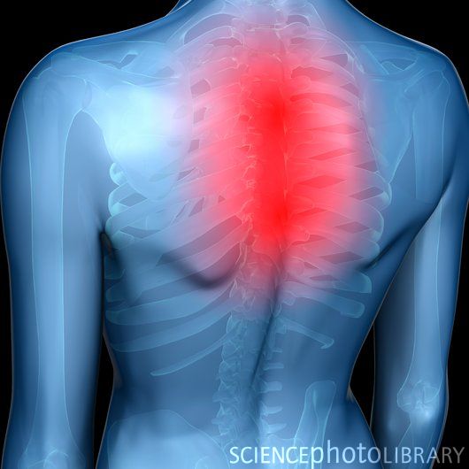 Upper body pain and incident musculoskeletal disorders among computer operators