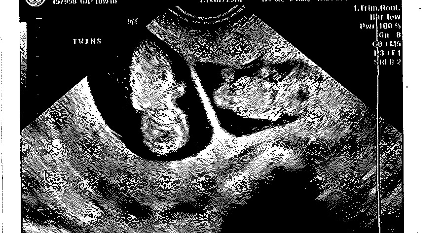 This Blog I Like: A Twin Pregnancy - and Birth