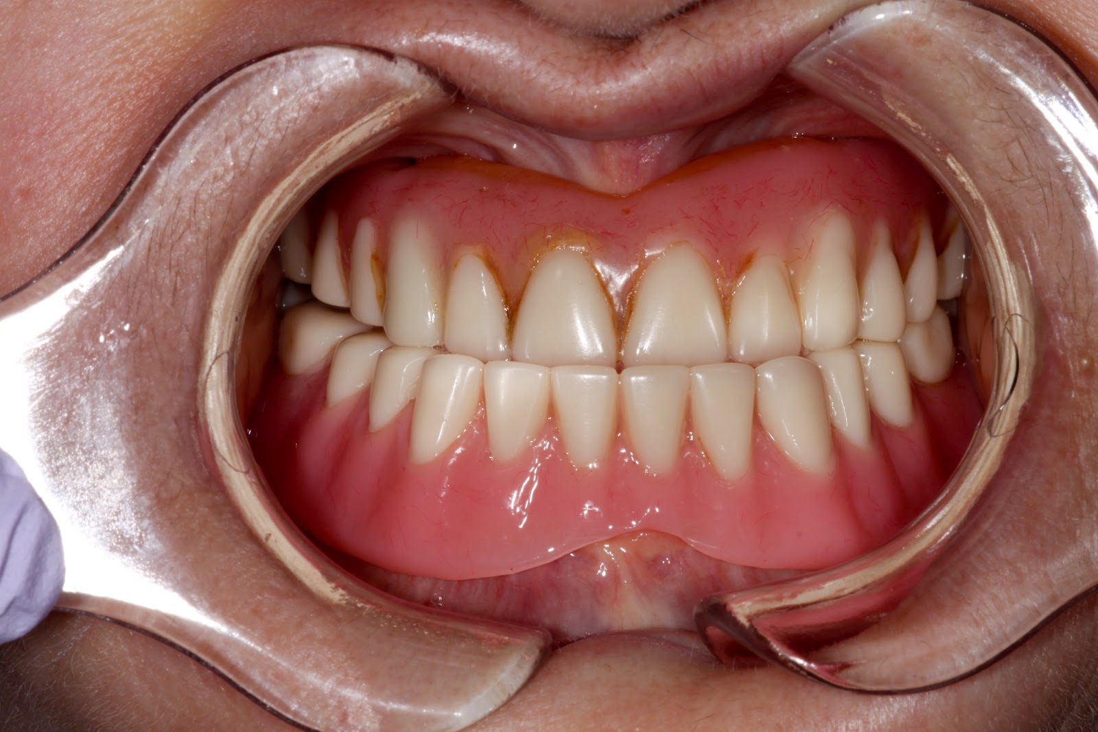 Boise Idaho Prosthodontics Maxillary Complete Denture / Mandibular