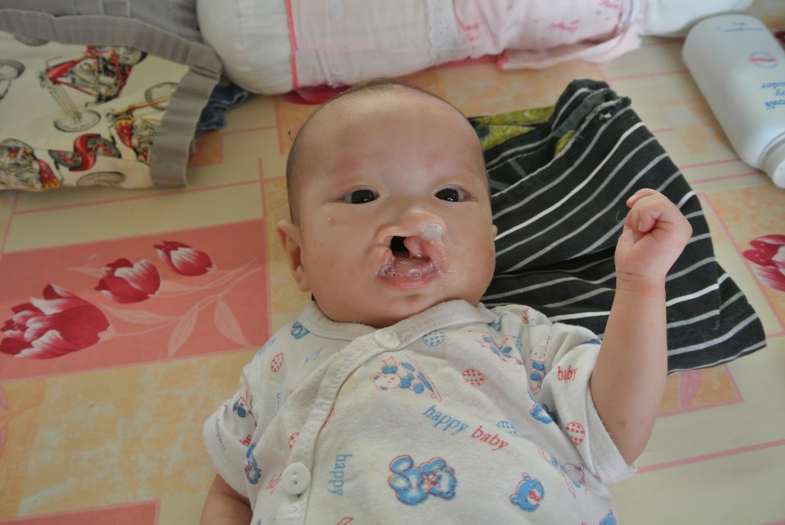 Babies with Cleft Palate Photo Cute Baby Wallpapers
