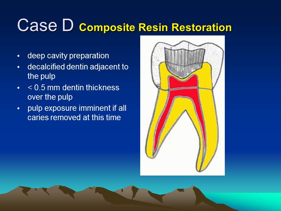 Difference Between Base And Liner In Dentistry at Connie Downs blog