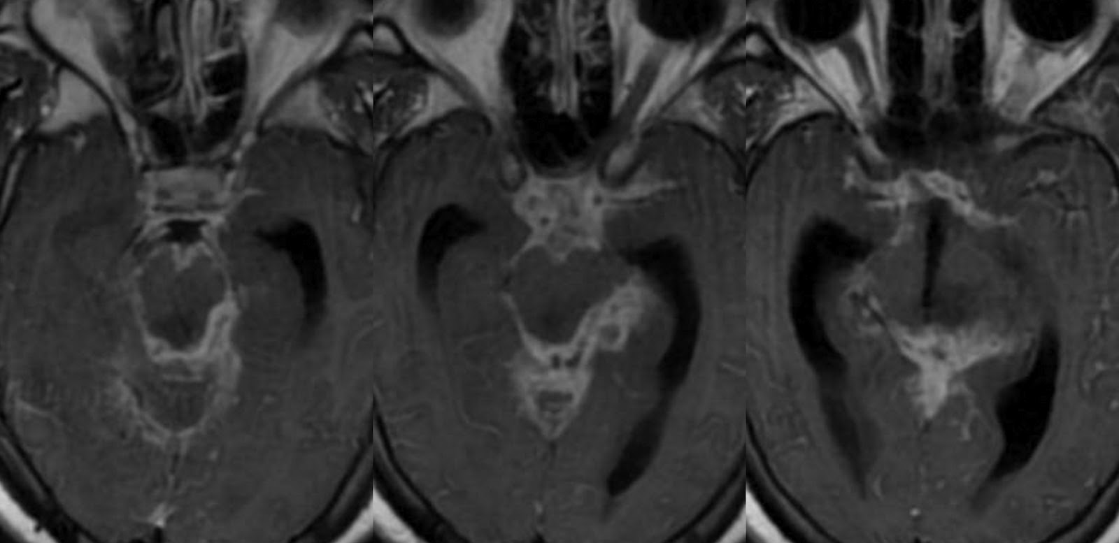 Dr Balaji Anvekar FRCR Basal exudates in Tuberculous meningitis