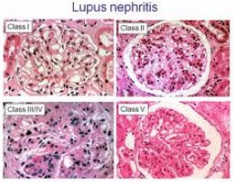 Steroid treatment for lupus nephritis