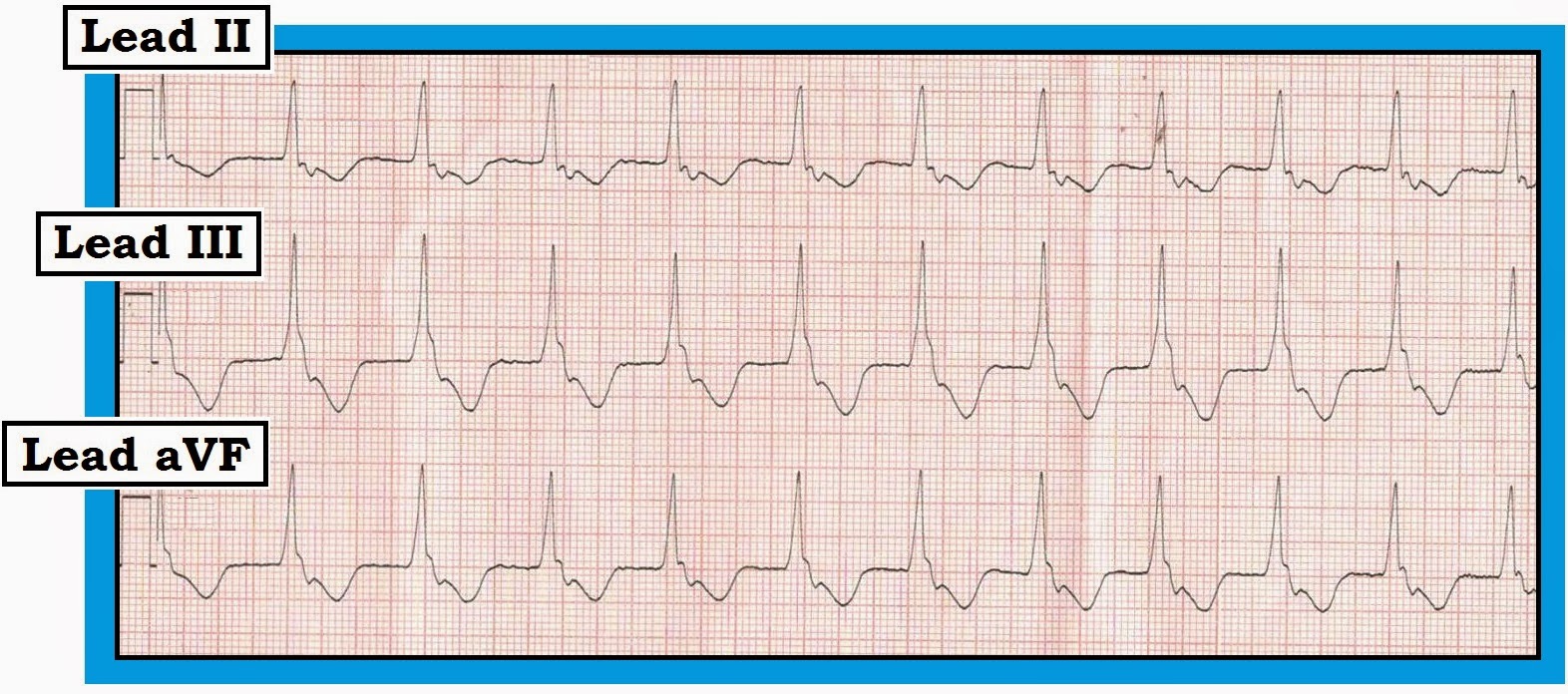 ECG Interpretation ECG Blog 107 (PVCs Couplets Echo Beats AIVR