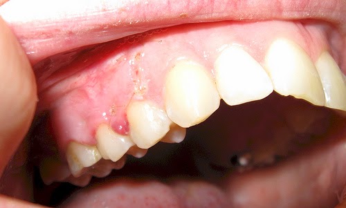 dental cyst