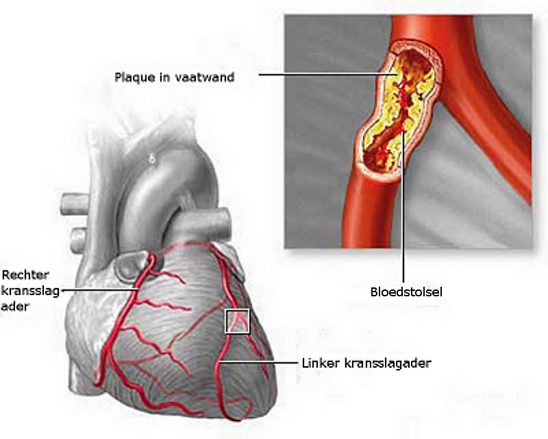 Gezondheidsweb Hartaanval (hartinfarct)