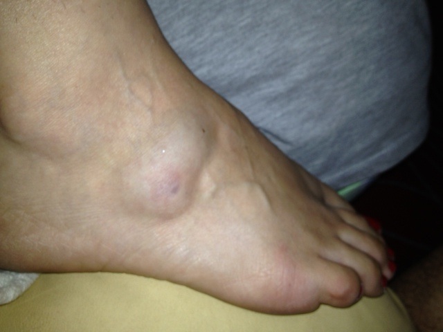 Swollen Foot Pain