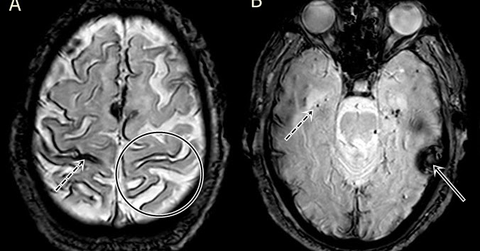 Neuroblog Siderosis superficial secundaria a angiopatía amiloide
