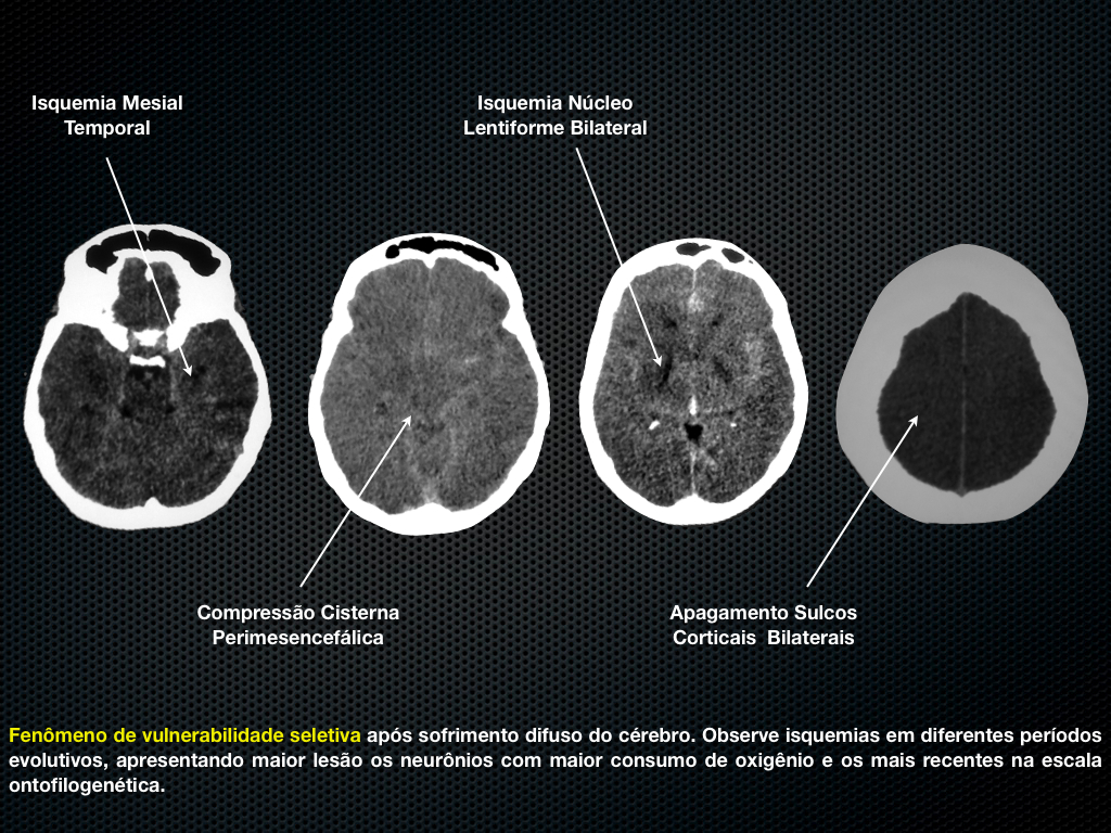 NEUROINTENSIVISMO Encefalopatia AnóxicoIsquêmica