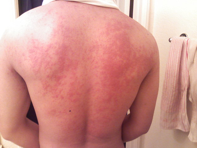 Seafood Allergy Home Remedy Seafood Allergy Home Remedy